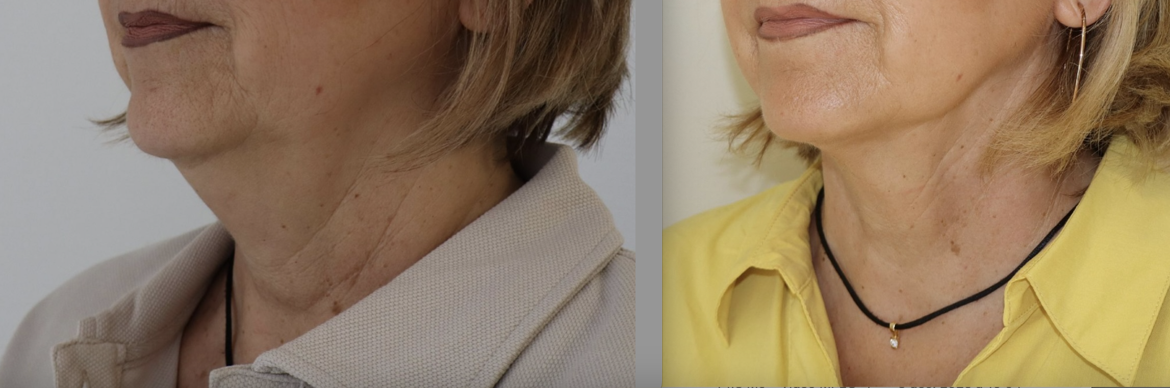 Avant/Après lipoaspiration cervicale